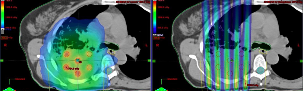 Spatially Fractionated Radiation Therapy